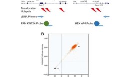 新的检测方法将彻底改变急性髓系白血病的检测和治疗