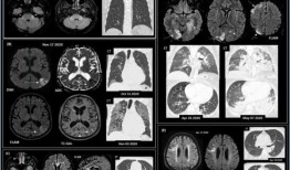 炎症可能将COVID-19的严重程度与神经系统症状的发作联系起来