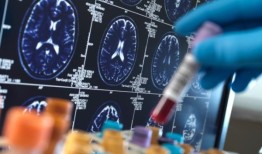 研究表明，阿尔茨海默病可以在人与人之间传播