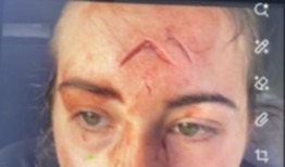 狗袭击：被朋友的狗咬伤的珀斯女子海莉·欧文斯分享了重要的警告