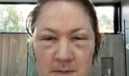 “娃娃脸工程”在百万富翁的脸上爆炸，因为他把别人的脂肪注射到脸上，导致严重的过敏反应